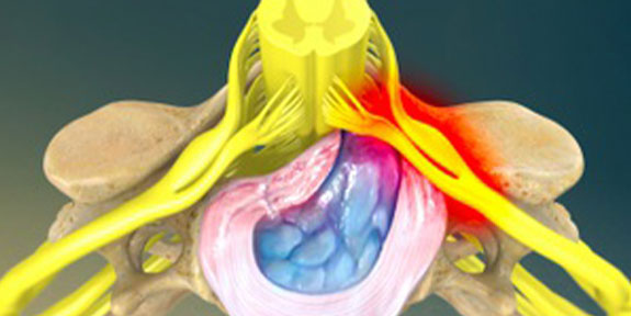 Herniated Disc Denver